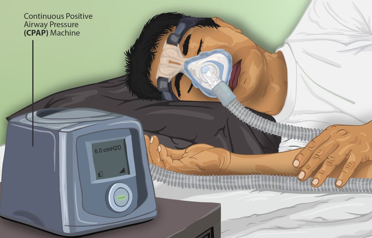 Alvásapnoés beteg CPAP-készülékkel, illusztráció