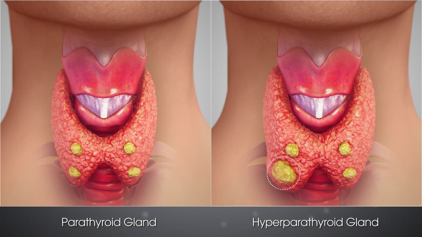 3D orvosi illusztráció: egészséges mellékpajzsmirigyek és megnagyobbodott (hyperparathyreoid) mellékpajzsmirigy összehasonlítása a pajzsmirigy mögött